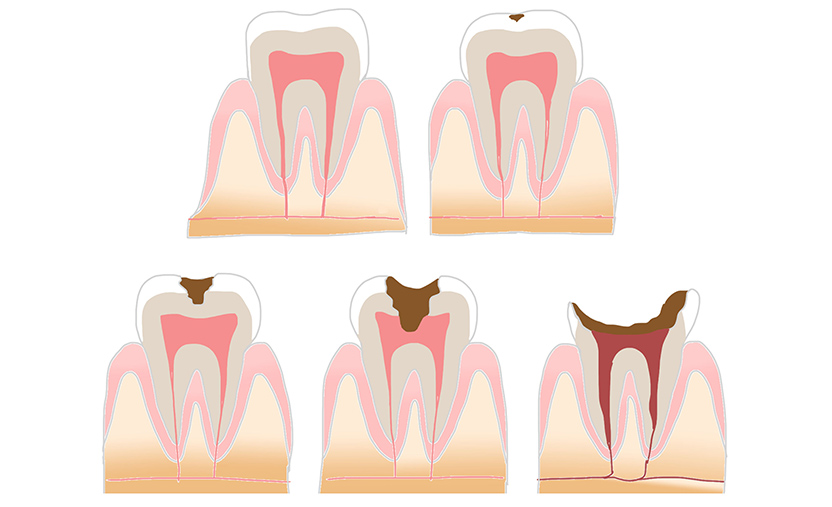 虫歯の経過
